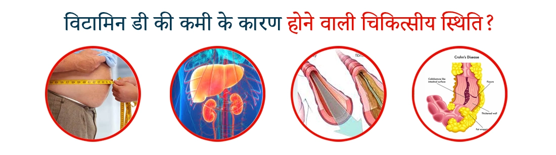 Medical conditions caused by vitamin D deficiency in Hindi